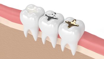 Silver Caps for Teeth: Understanding Their Purpose and Applications