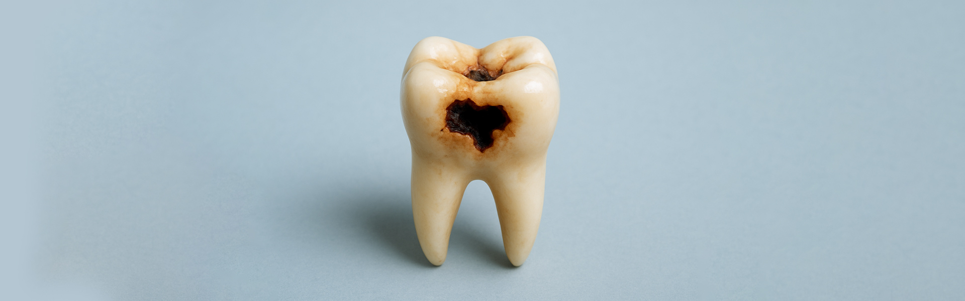 Cavity Between Teeth? How to Spot and Treat It Fast