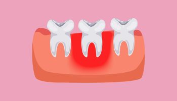 Why is my gum swollen around one tooth in the back?